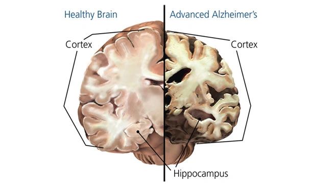 How Does Alzheimers Disease Affect The Brain 1952